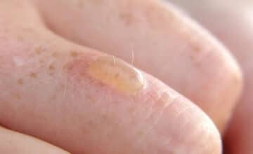 How do you treat a burn blister 1250x600 1