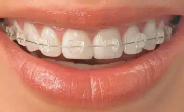 Invisalign ceramic braces 0